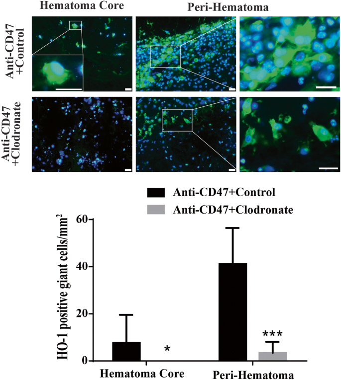 Multinucleated Giant Cells In Experimental Intracerebral Hemorrhage Springerlink