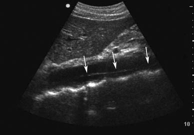 Bedside Diagnosis Of Extensive Aortic Dissection The Ultrasound
