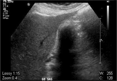 The significance of the wall echo shadow triad on ultrasonography