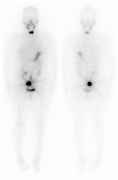 Ovarian Teratoma Mimicking Metastasis On I 131 Scan A Case Report Springerlink