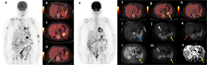 Rare Nodular Hepatosplenic Involvement in Multiple Myeloma: FDG PET/CT ...