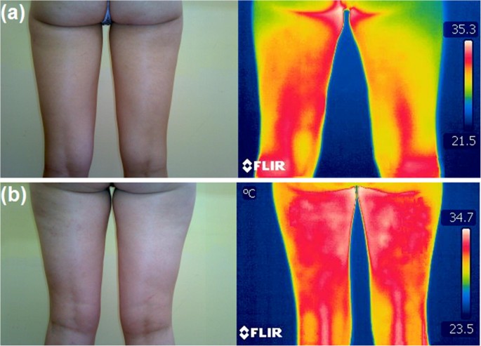 Implementation of artificial intelligence and non-contact infrared thermography for prediction and personalized automatic identification of different stages of cellulite | SpringerLink