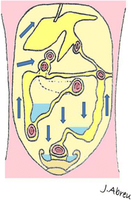 Flow Induces Epithelial Mesenchymal Transition Cellular Heterogeneity And Biomarker Modulation In 3d Ovarian Cancer Nodules Pnas