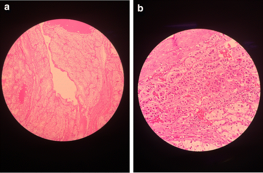 Metastases Of Renal Cell Carcinoma To The Contralateral Adrenal Gland Managed By Laparoscopic Adrenalectomy Springerlink