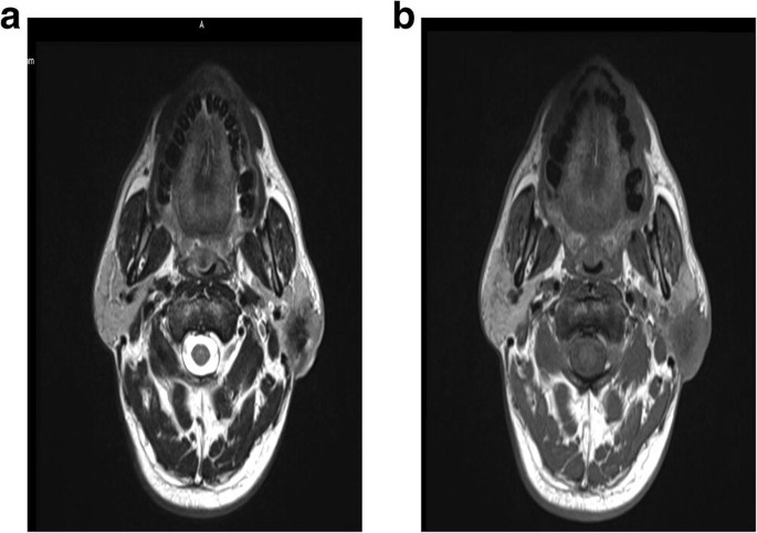 Salivary Duct Carcinoma Of Parotid Gland A Rare Tumor Springerlink