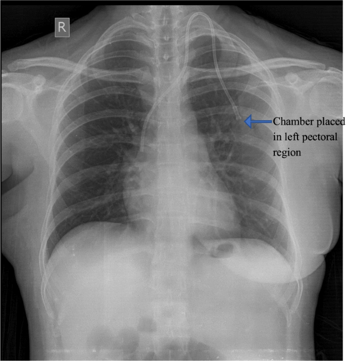 Chemoport-associated Complications and Its Management | Indian ...