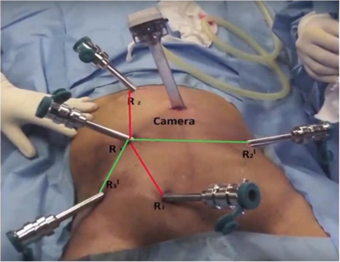 Robotic Surgery For Rectal Cancer: Hype Or Hope? (Indian Experience) |  Springerlink