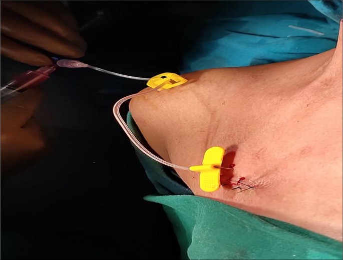 Chemoport Insertion—Less Is More | SpringerLink