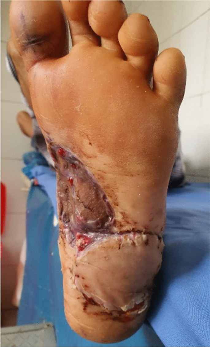scream their circuit Reconstruction and Outcome of Foot Defects Following Oncological Resection-Experience from a Cancer Centre in North-East India | SpringerLink scream their circuit Reconstruction and Outcome of Foot Defects Following Oncological Resection-Experience from a Cancer Centre in North-East India | SpringerLink