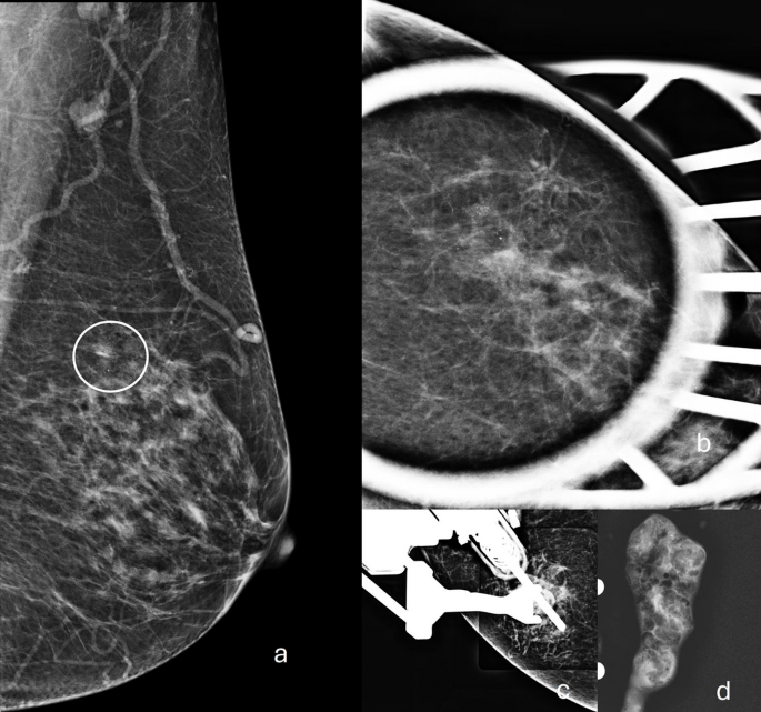 Grouped Amorphous Micro-Calcifications Detected on Screening Mammogram ...