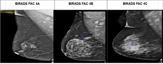 Clinicopathological Correlation of BI-RADS FAC 4 Breast Lesions: A ...