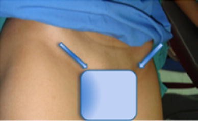 Complete Androgen Insensitivity Syndrome Springerlink