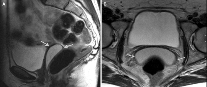 Gartner Duct Cyst: CT and MRI Findings | SpringerLink Gartner Duct Cyst: CT and MRI Findings | SpringerLink