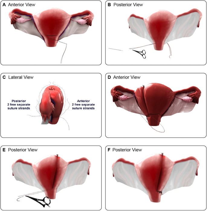 Comoc Mg Stitch Modification Of B Lynch Suturing Technique To Control Atonic Post Partum Haemorrhage Springerlink