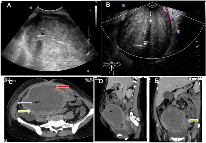 Imaging In Uncommon Pelvic Complications Of Pregnancy A Pictorial Essay Springerlink Imaging In Uncommon Pelvic Complications Of Pregnancy A Pictorial Essay Springerlink