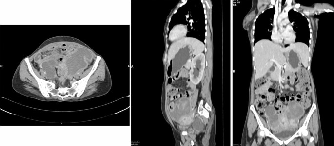 Primary Extra Uterine Endometrial Stromal Sarcoma And Synchronous Breast Cancer A Double Whammy A Case Report Springerlink