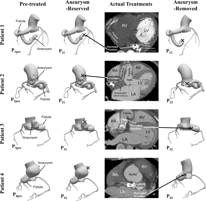 Role of Occlusion Position in Coronary Artery Fistulas with Terminal  Aneurysms: A Hemodynamic Perspective | SpringerLink