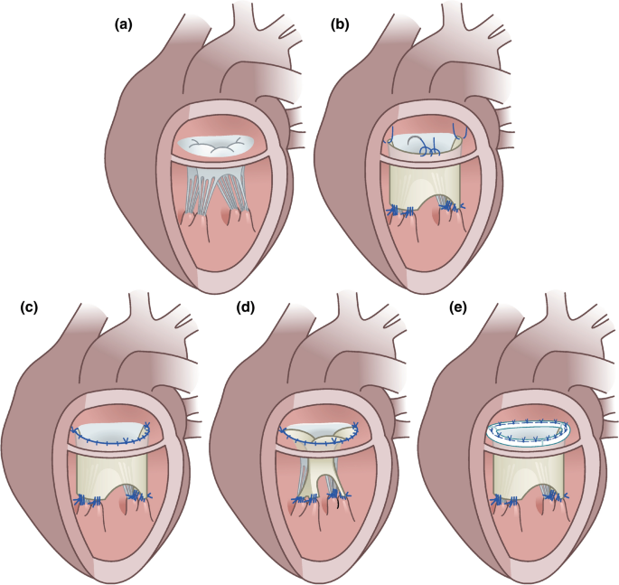 Valvular Disease - TeachMeSurgery