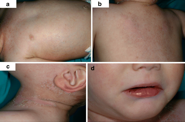 Kawasaki Disease A Review With Emphasis On Cardiovascular Complications Insights Into Imaging Full Text