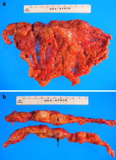 Transvaginal sonographic features of peritoneal carcinomatosis