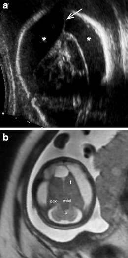 Non Visualisation Of Cavum Septi Pellucidi Implication In Prenatal Diagnosis Insights Into Imaging Full Text Non Visualisation Of Cavum Septi Pellucidi Implication In Prenatal Diagnosis Insights Into Imaging Full Text