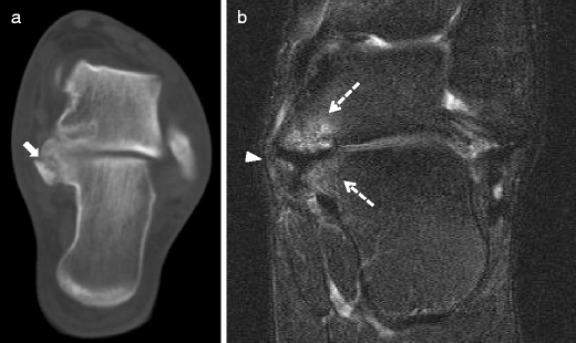 talocalcaneal coalition mri