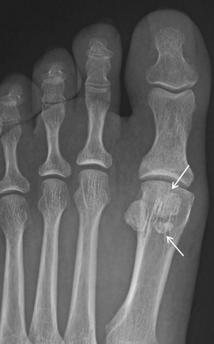 Sesamoids and accessory ossicles of the foot: anatomical variability and  related pathology | Insights into Imaging | Full Text