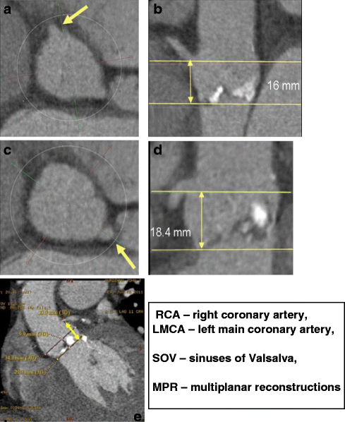 Imaging in Transcatheter Aortic Valve Replacement (TAVR): role of the  radiologist | SpringerLink