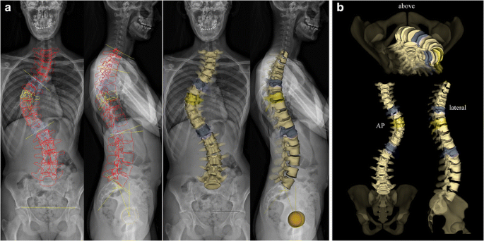 Idiopathic Scoliosis In Children And Adolescents Assessment With A Biplanar X Ray Device Insights Into Imaging Full Text