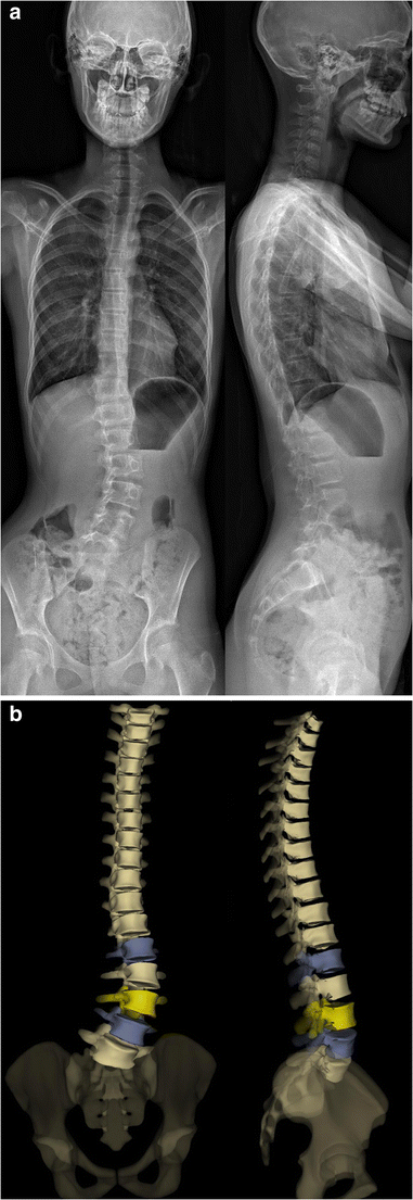 Idiopathic Scoliosis In Children And Adolescents Assessment With A Biplanar X Ray Device Insights Into Imaging Full Text