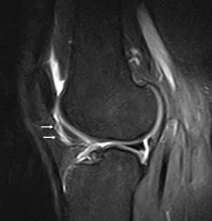 Coping sacred Plant Hoffa's fat pad abnormalities, knee pain and magnetic resonance imaging in  daily practice | Insights into Imaging | Full Text
