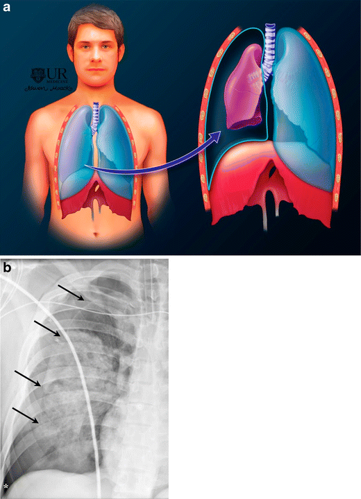 pneumothorax chest tube