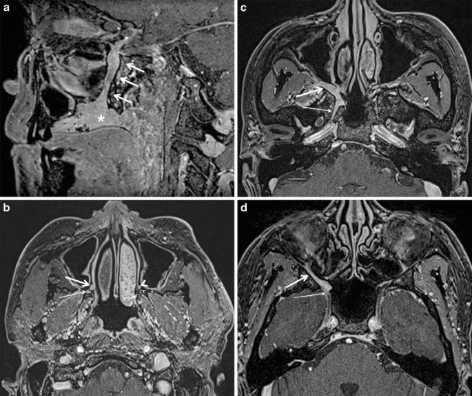 pterygopalatine fossa mri