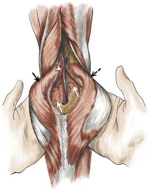 Uncommon Diseases Of The Popliteal Artery A Pictorial Review Insights Into Imaging Full Text Uncommon Diseases Of The Popliteal Artery A Pictorial Review Insights Into Imaging Full Text