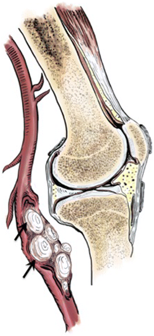 popliteal artery and vein