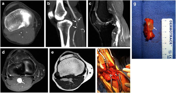 Uncommon Diseases of The Popliteal Artery: A Pictorial Review | Insights  into Imaging | Full Text