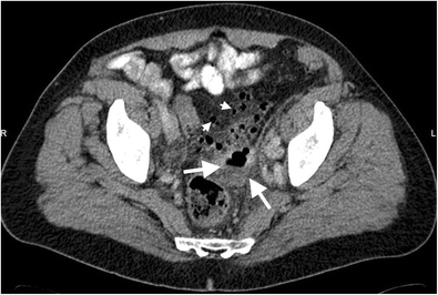 Diverticulitis: a comprehensive with usual and unusual | Insights Imaging | Full Text