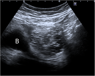 subcutaneous dermoid cyst ultrasound