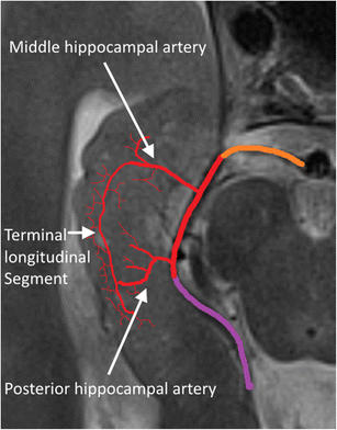 mri hippocampus anatomy mri hippocampus anatomy