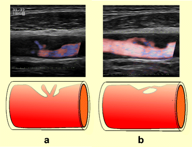 Imaging of the ulcerated carotid atherosclerotic plaque: a review of the  literature | Insights into Imaging | Full Text