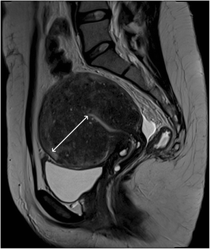 MRI for adenomyosis: a pictorial review | Insights into Imaging | Full Text