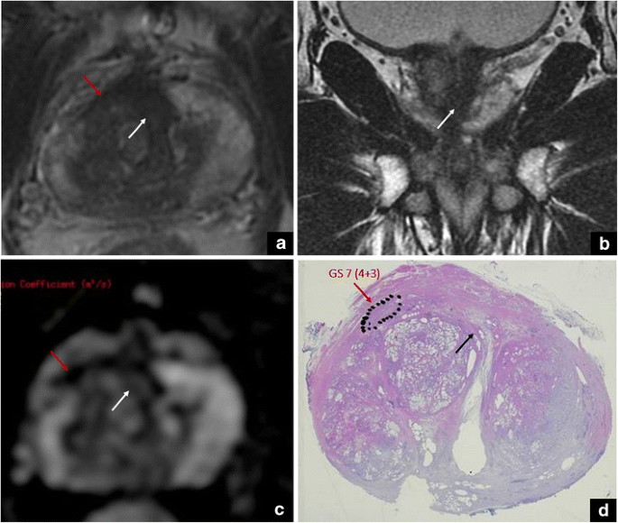 Prostate mri pitfalls radiology, A könyvről MRI of the Prostate