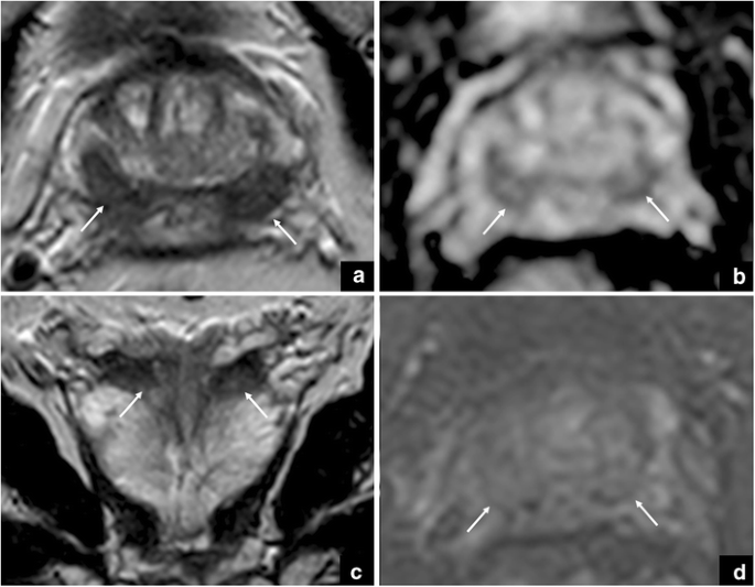 prostate mri pitfalls radiology