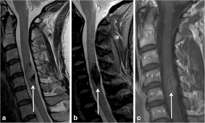 Location, length, and enhancement: systematic approach to differentiating  intramedullary spinal cord lesions | Insights into Imaging | Full Text