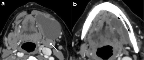 submandibular gland cyst