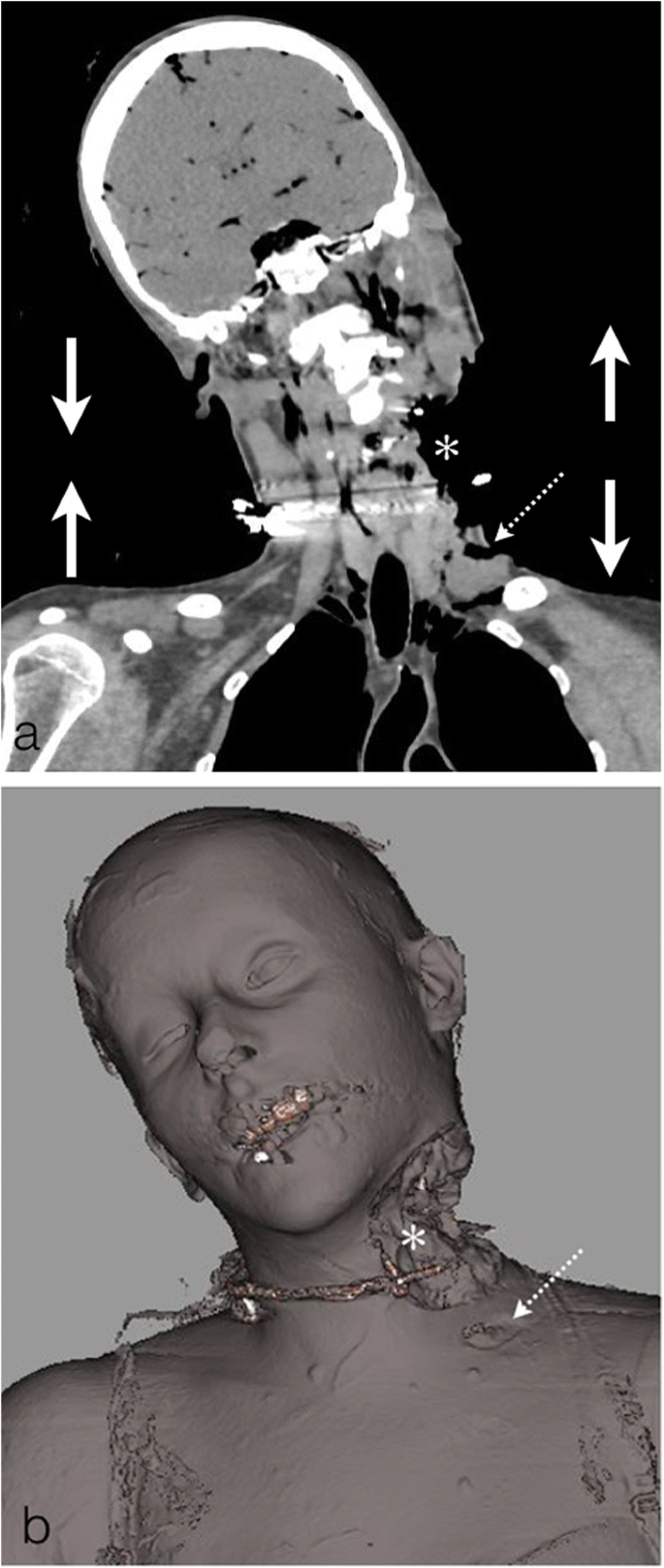 Burned bodies: post-mortem computed tomography, an essential tool for  modern forensic medicine | Insights into Imaging | Full Text