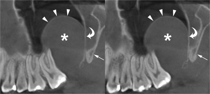 odontogenic keratocyst radiology