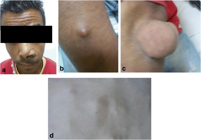 type 3 neurofibromatosis type 3 neurofibromatosis