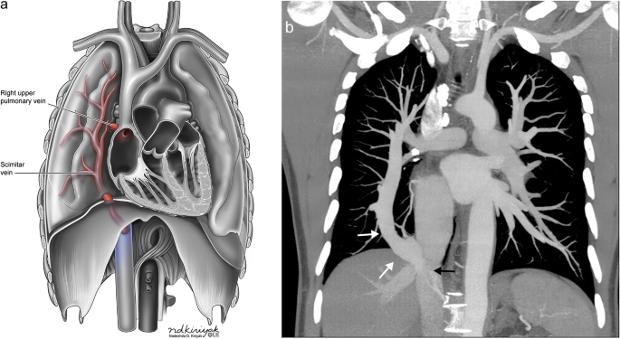 Anatomy of the lungs, mediastinum and heart at MDCT