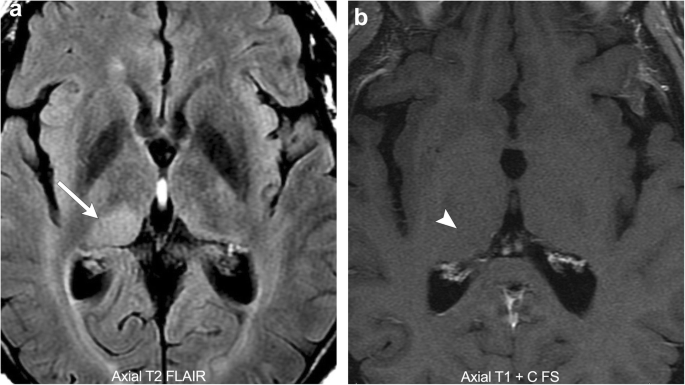 brain mri scan tumor